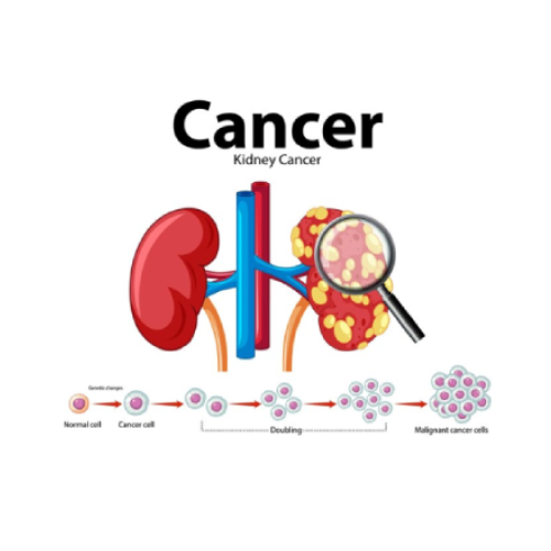 Kidney Cancer